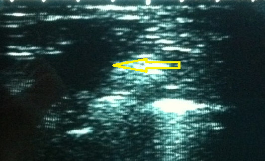 Ultraschall 28 Tag zugeschnitten